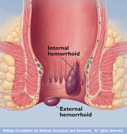 Hemorrhoid Pic